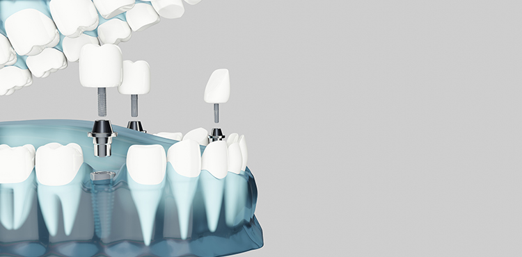 Fog implantátum beültetés menete és kivitelezése