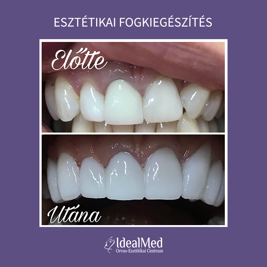 Előtte-Utána Esztétikai fogkiegészítés 10