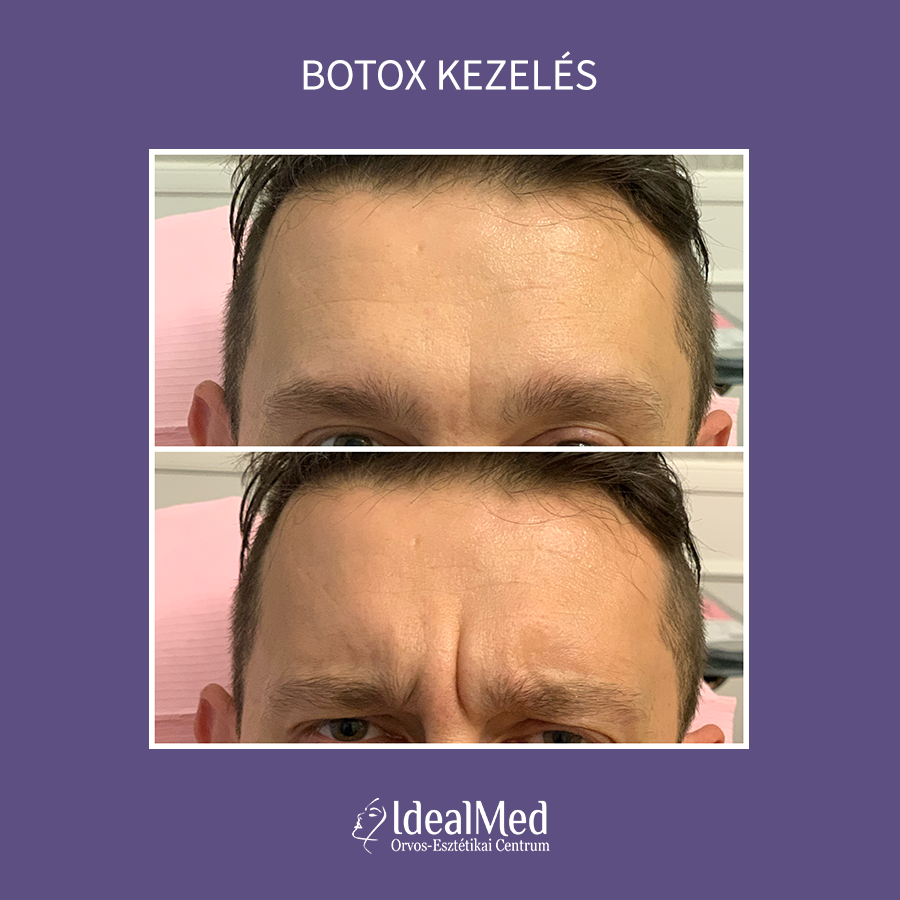 Előtte-Utána Botox kezelés01